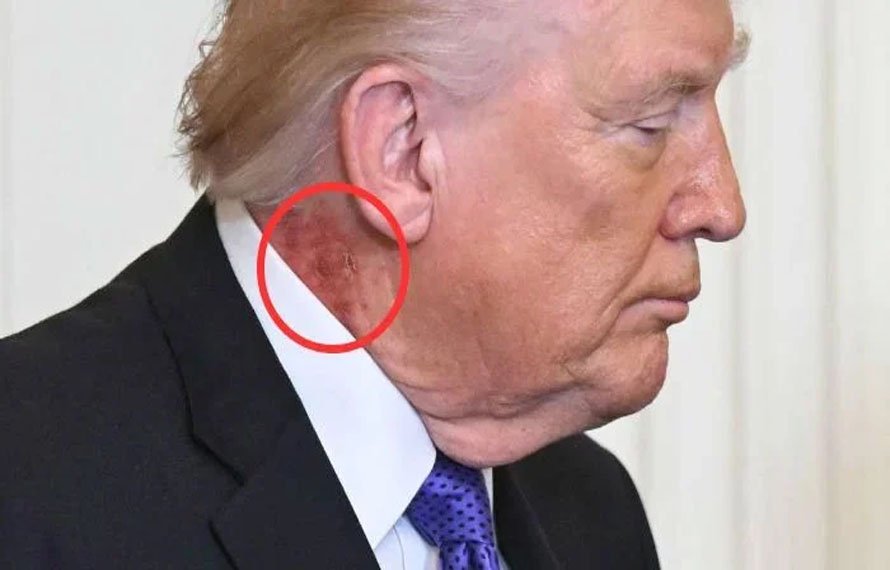 عوامی تقریب میں ٹرمپ کی گردن پر سرخ نشان، صحت سے متعلق سوالات نے پھر شدت اختیار کر لی